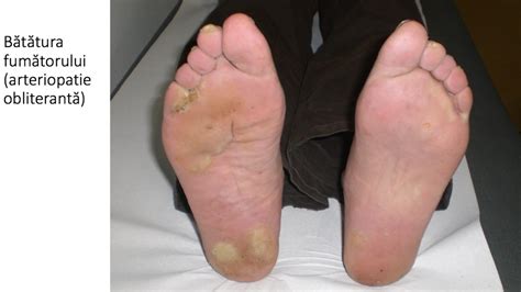 varicele piciorului provoacă o fotografie de tratament
